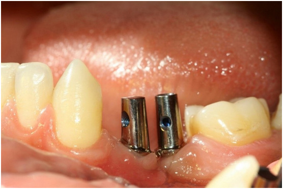 The suitable angled & straight abutment were chosen