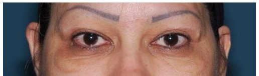 Results of the transconjunctival apporeach before and after the surgery