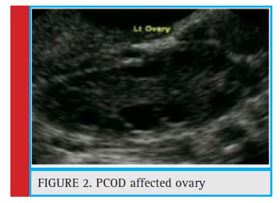 PCOD affected ovary