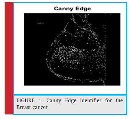 Canny Edge Identifi er for the Breast cancer