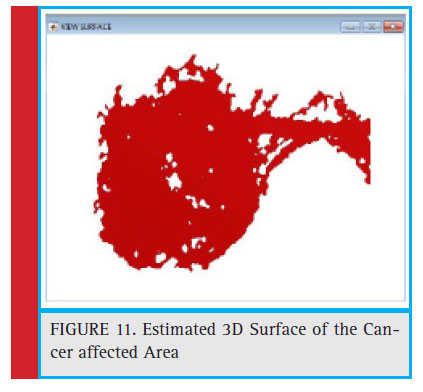 Estimated 3D Surface of the Cancer affected Area
