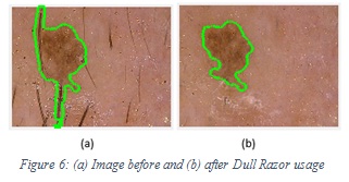 Figure 6: (a) Image before and (b) after Dull Razor usage