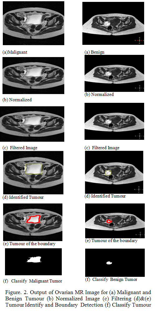 Figure. 2. Output of Ovarian MR Image for (a) Malignant and Benign Tumour (b) Normalized Image (c) Filtering (d)&(e) Tumour Identify and Boundary Detection (f) Classify Tumour