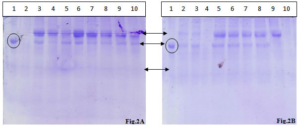 Fig 2: SDS PAGE analysis of urinary proteins extracted from two different samples.