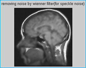 Figure 13. Removing noise by wiener filter