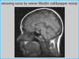 Figure 7: Removing noise by wiener filter
